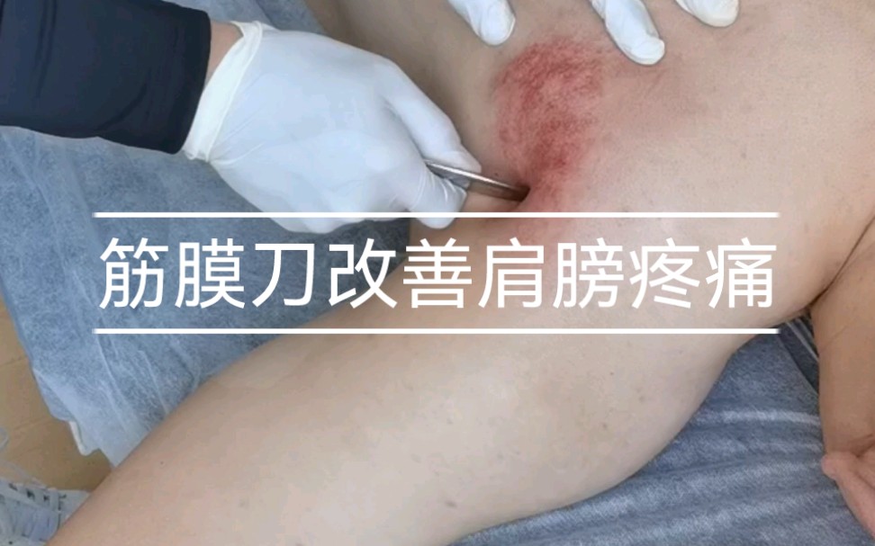 筋膜刀深层放松改善肩膀疼痛