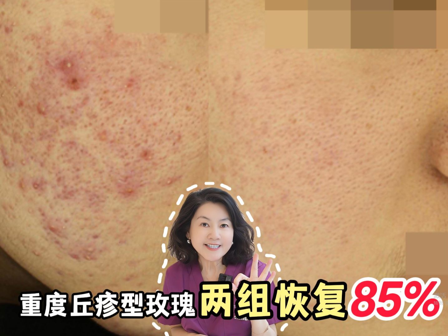 红脸蛋请看,重度丘疹型玫瑰痤疮改善85%!