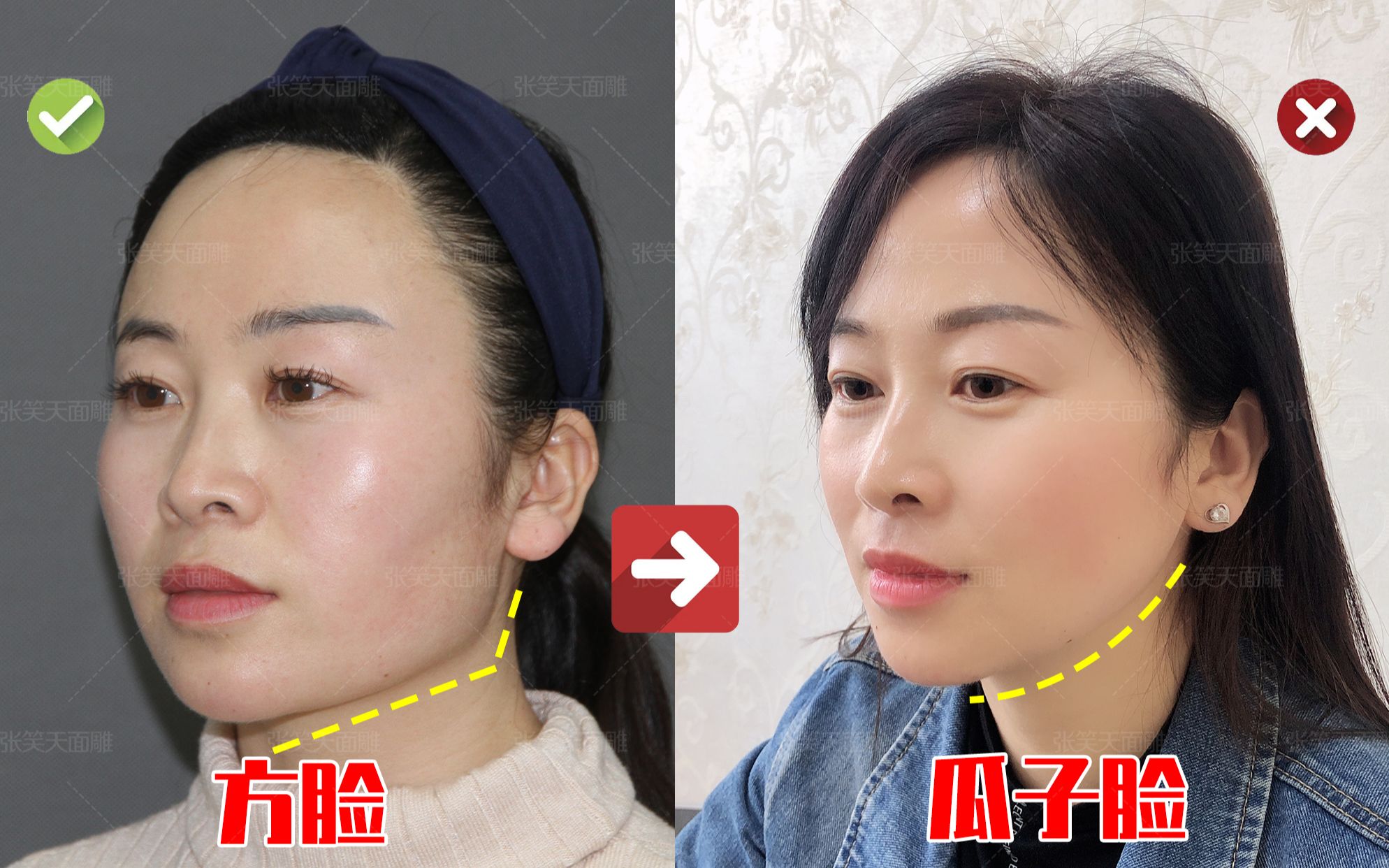 张笑天短方脸正面宽下颌角手术后14天脸小了轮廓线流畅多了