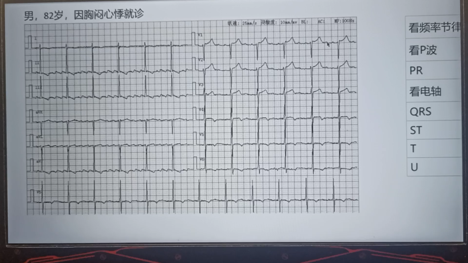 每天一份心电图0421,心房扑动哔哩哔哩bilibili