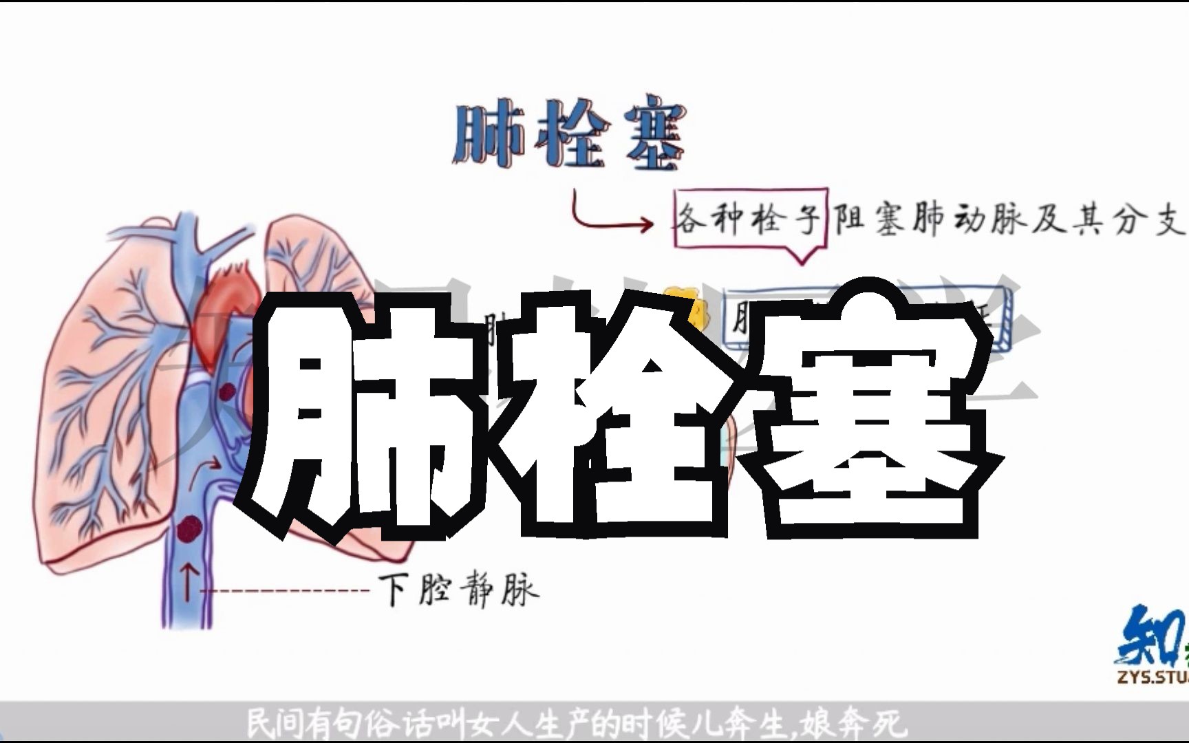 医学手绘演绎 肺栓塞哔哩哔哩bilibili