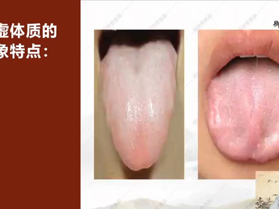 [图]26.舌诊调理九种体质.26.舌诊调理九种体质：湿热体质的舌象及调理方法