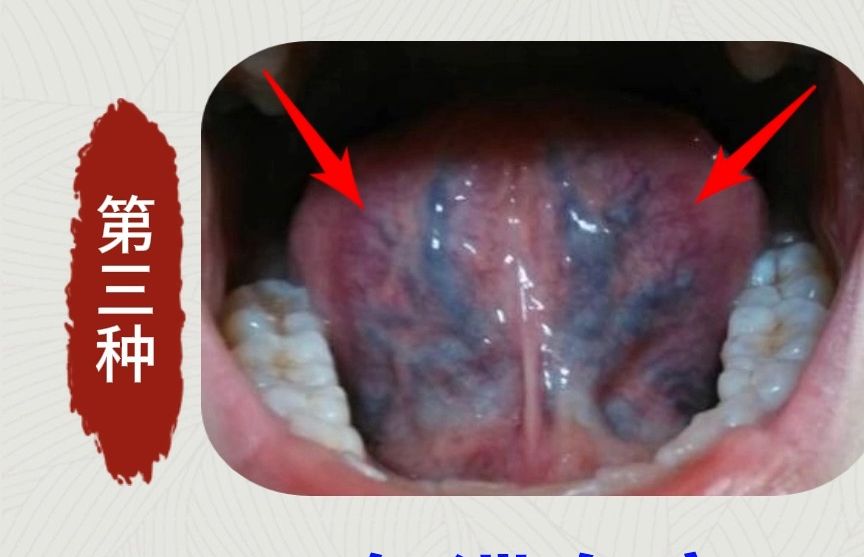 身体哪里有瘀堵,看看舌下就知道!4种瘀堵对照一下你是哪种?哔哩哔哩bilibili