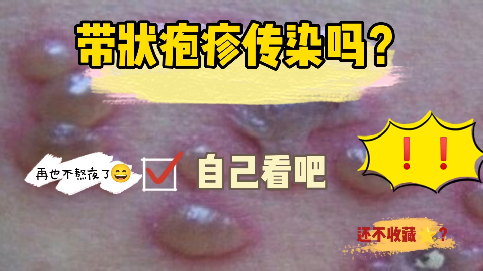 请注意!!这几类人群易感带状疱疹!哔哩哔哩bilibili