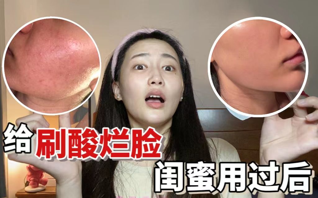 活动作品刷酸烂脸大冤种闺蜜的救星如何正确修复