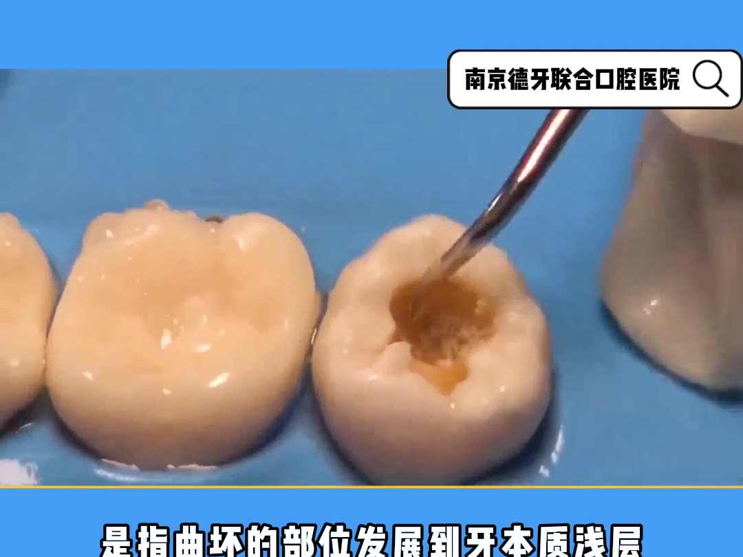 什么是龋齿?咱们该怎么办?