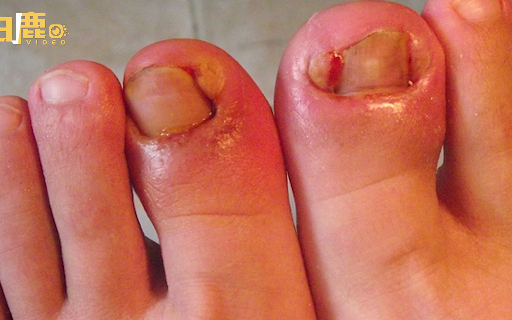 15岁男孩爱抠趾甲抠出甲沟炎_哔哩哔哩_bilibili