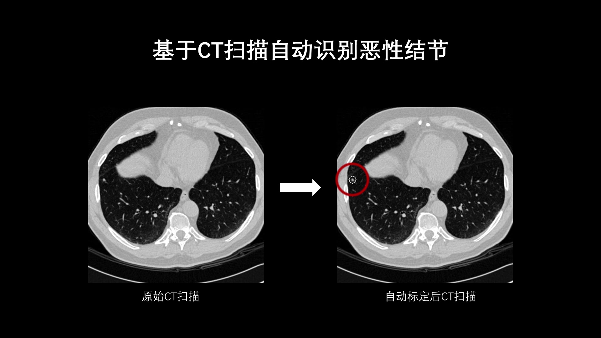 基于深度网络的肺结节检测与诊断 uic fyp