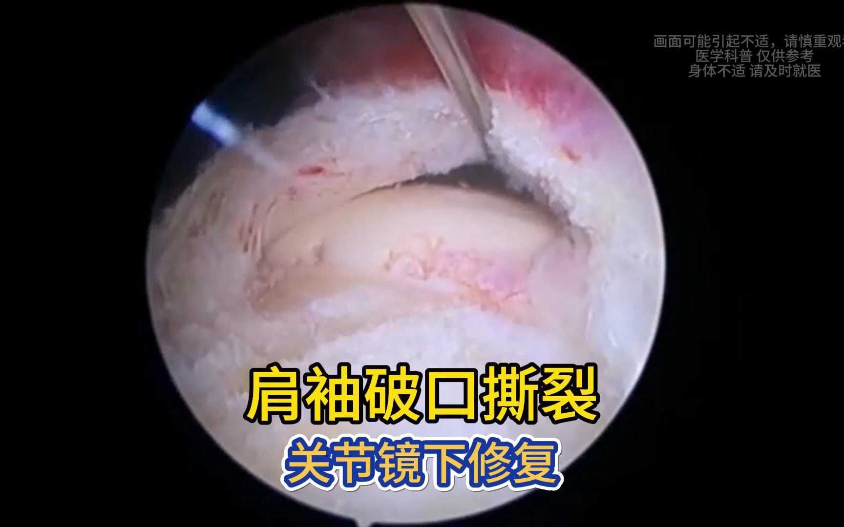 单个锚钉修复肩袖小型破裂