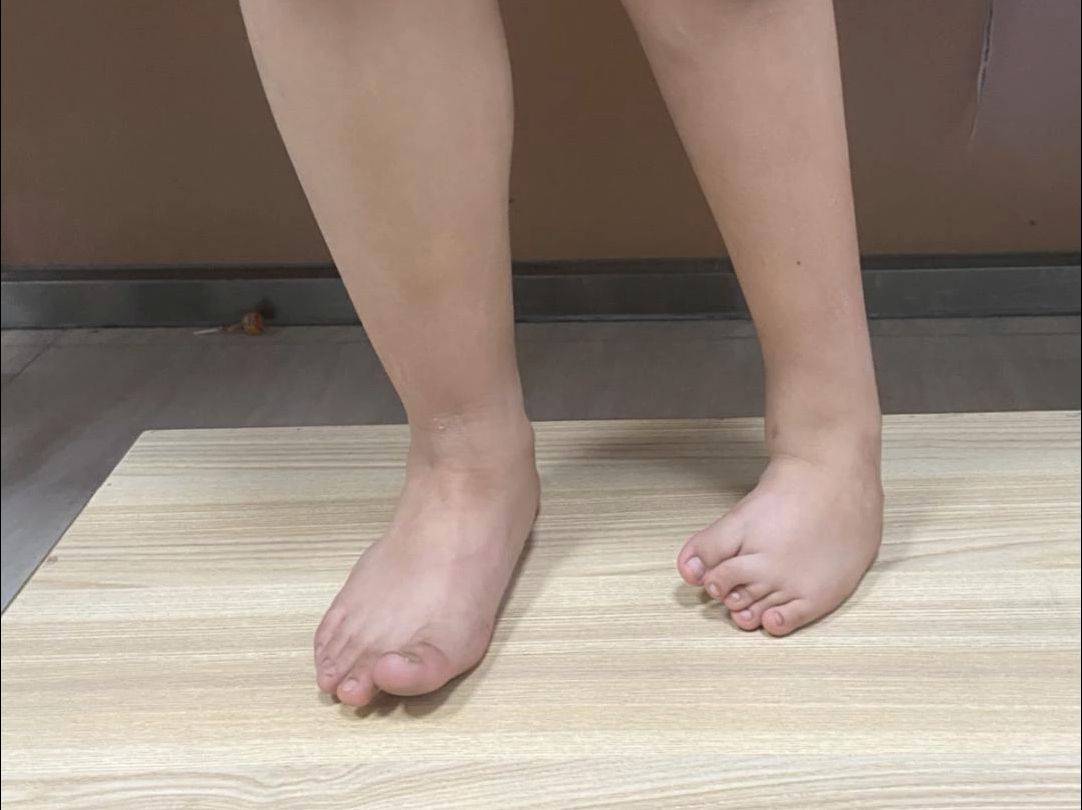 10岁男孩左脚畸形多年,一直受到异样眼光.医生:耐心一点