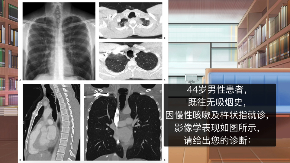 44岁男性患者,慢性咳嗽及杵状指,气管明显扩张,应如何诊断?哔哩哔哩bilibili