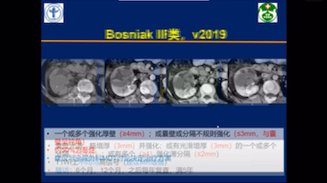 张洁肾脏囊性疾病的影像学诊断  bosniak分类2019版哔哩哔哩bilibili