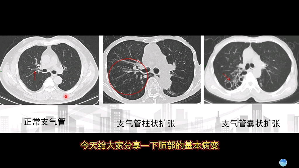 肺部基本影像科普:支气管及支气管扩张在CT上的典型征象!哔哩哔哩bilibili