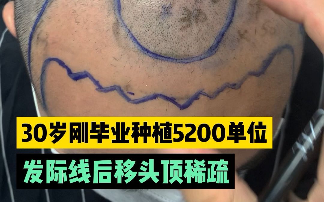 男生发际线后移+头发稀疏,大面积种植5200毛囊单位哔哩哔哩bilibili