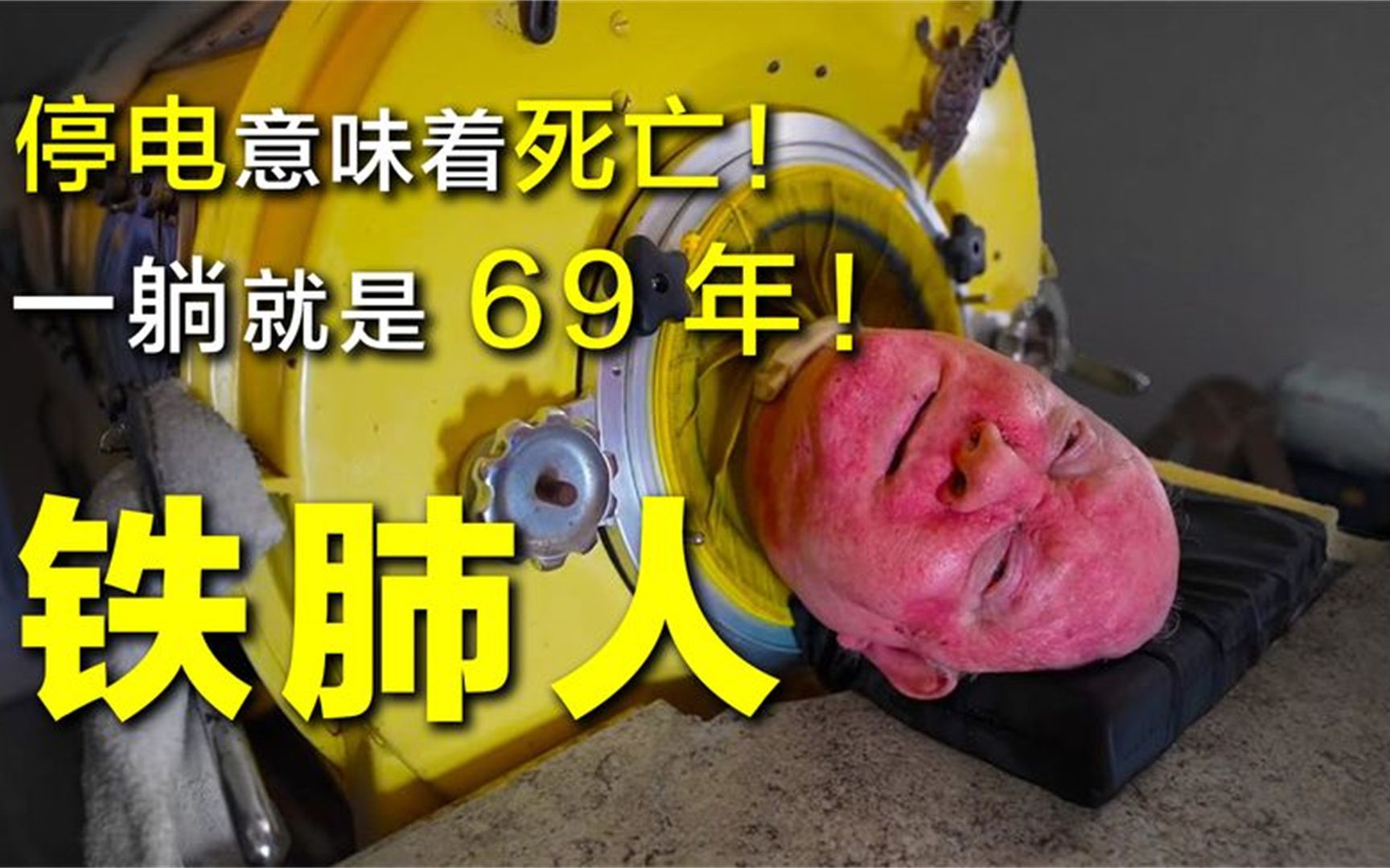 最后一个"铁肺人"!"铁棺材"里躺了六十年!停电就会死!