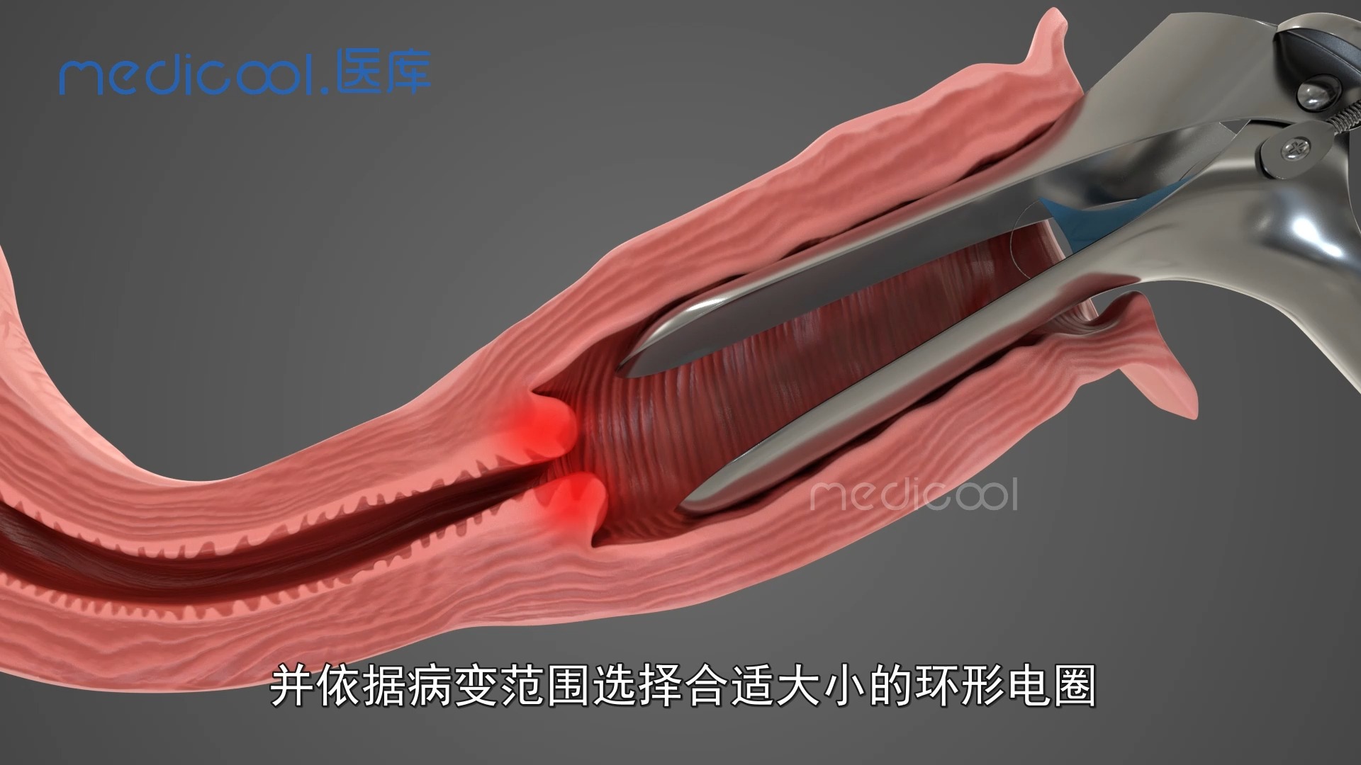 新型微创治疗宫颈病变,宫颈电热圈环切手术哔哩哔哩bilibili