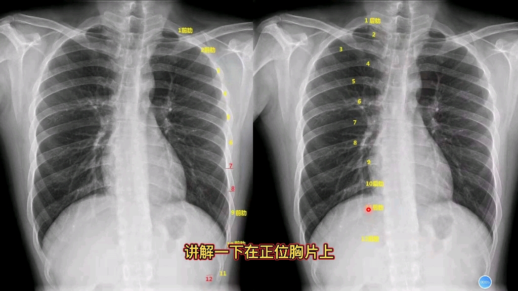 影像解剖:正位胸片上如何数肋骨?放射科医生讲解