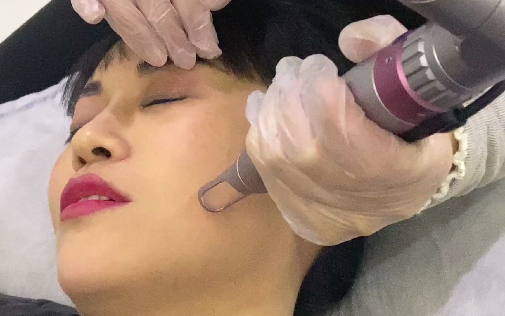 免费体验了一次超皮秒激光祛痣项目雷翡士