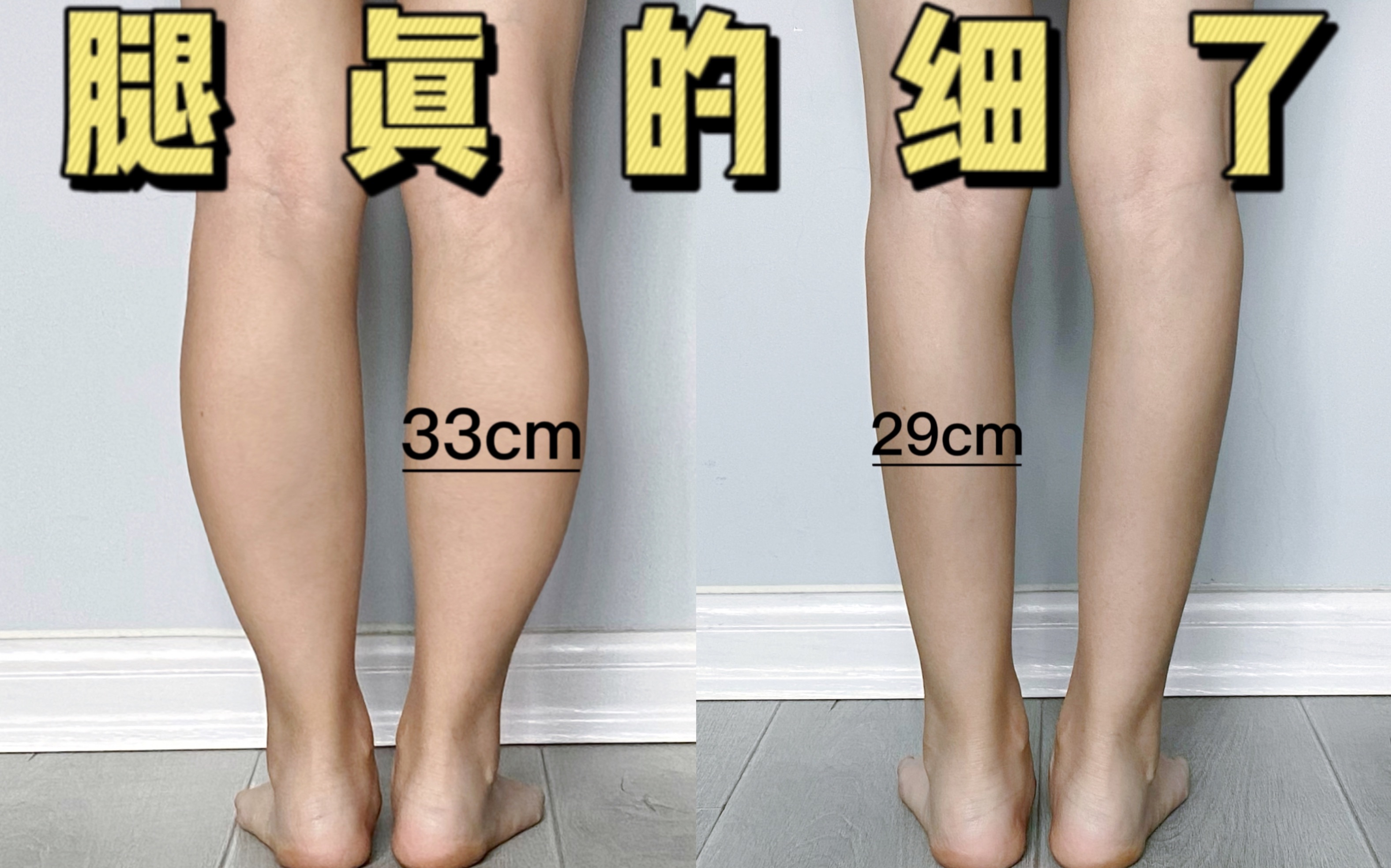 大腿肌肉外翻腿型图片图片
