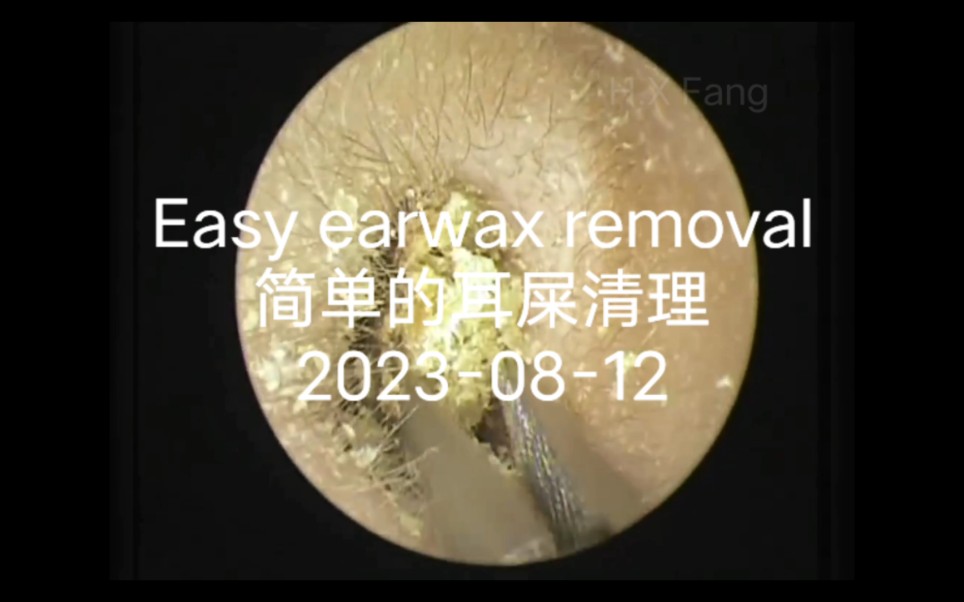 专业可视采耳耳垢和死皮清除Ear wax removalDead skin cleaning 20231124.02哔哩哔哩bilibili