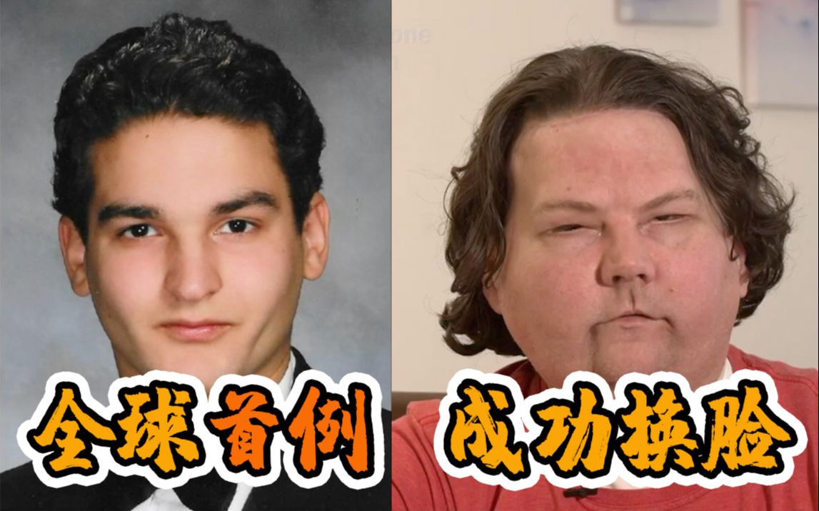 活动作品全球首例美国一男子成功换脸换手