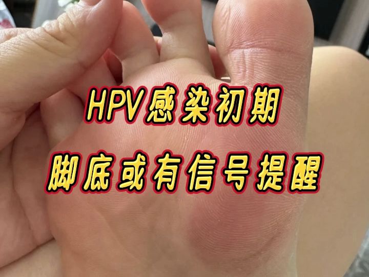 脚底人乳头瘤病毒图片图片