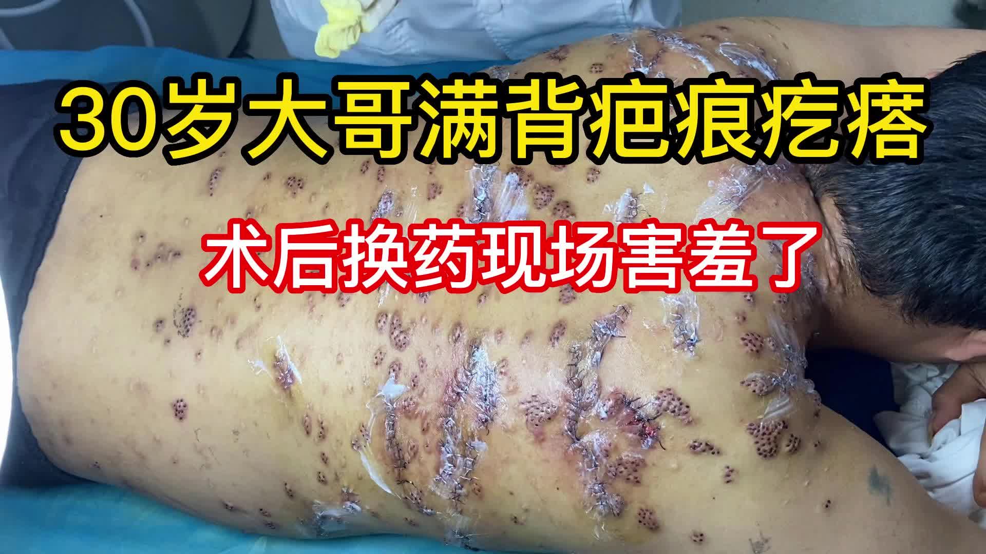 30岁大哥满背疤痕疙瘩,换药现场壮观宛如世界地图哔哩哔哩bilibili