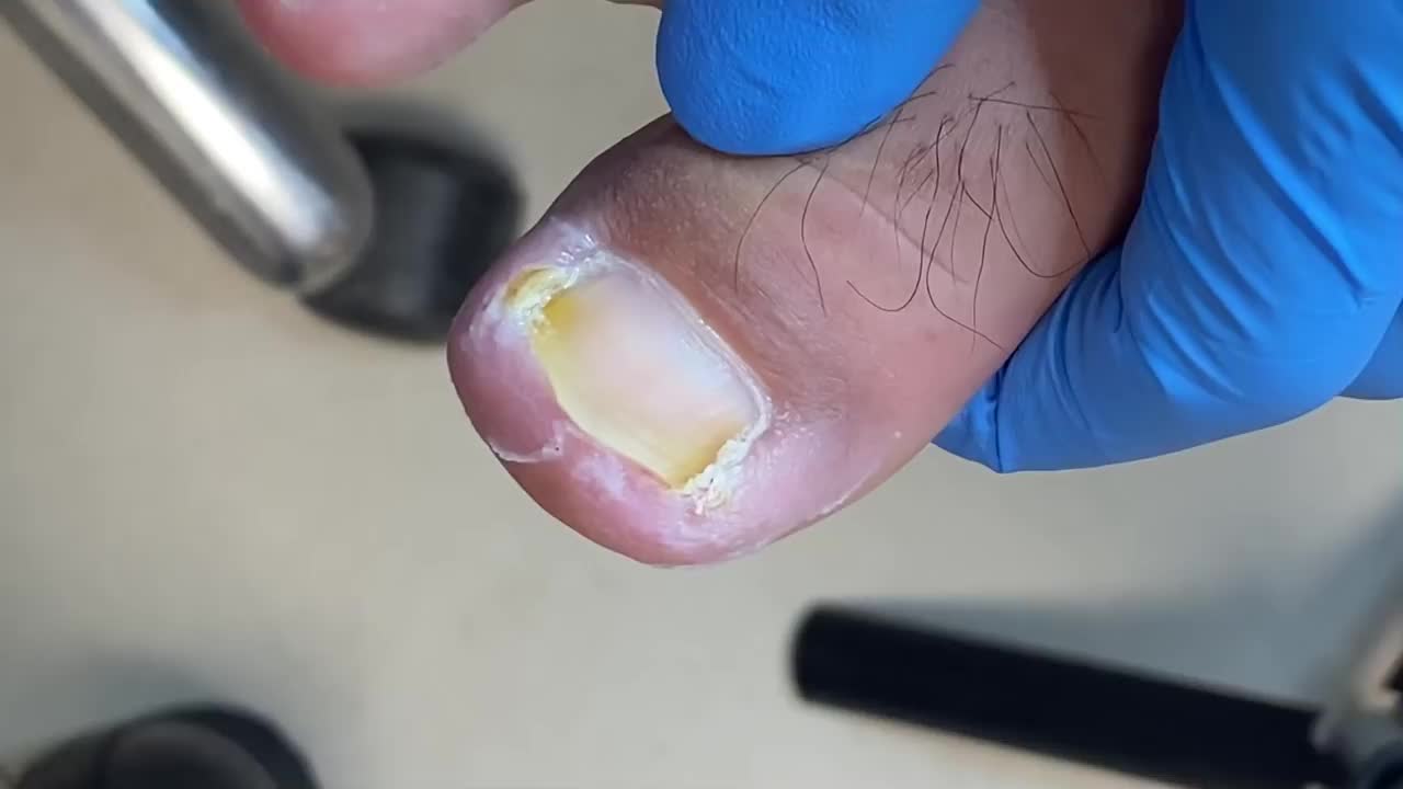 患者错误地治疗嵌甲可能会导致严重的病情