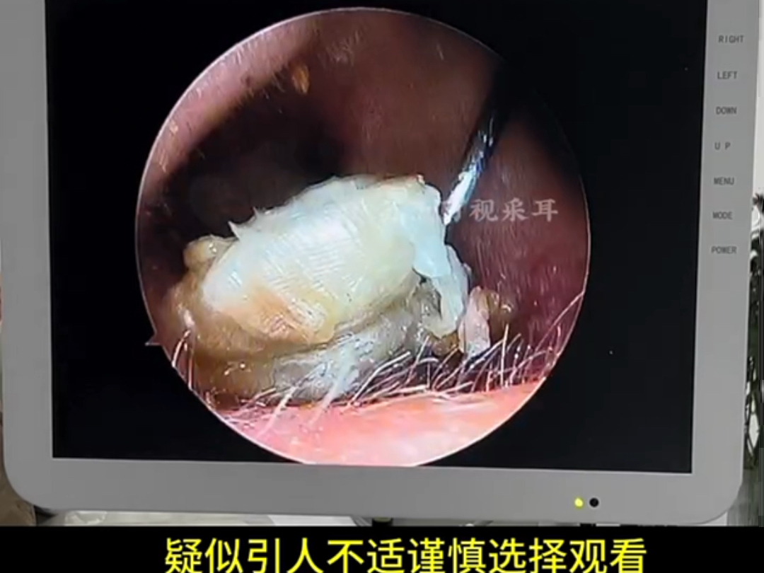 采耳,耳朵里堵发炎了