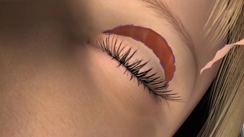 上眼睑提拉术手术过程,3d演示.