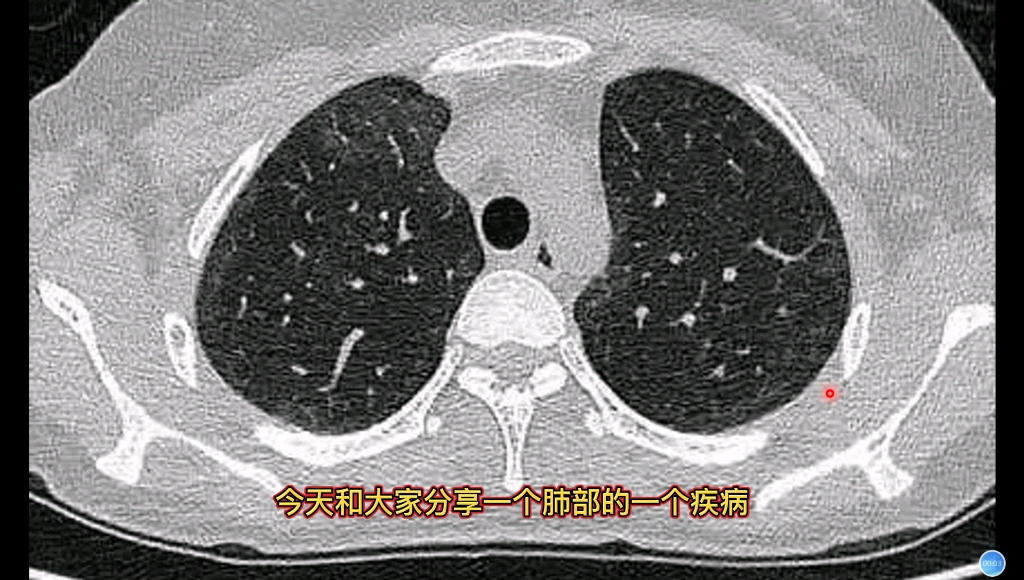 27岁女性,HIV阳性,CT发现肺部多发磨玻璃影,诊断什么?哔哩哔哩bilibili