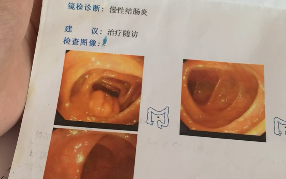 胃溃疡十二指肠溃疡结肠溃疡该怎么治疗是否早上起来肚子不舒服大便不