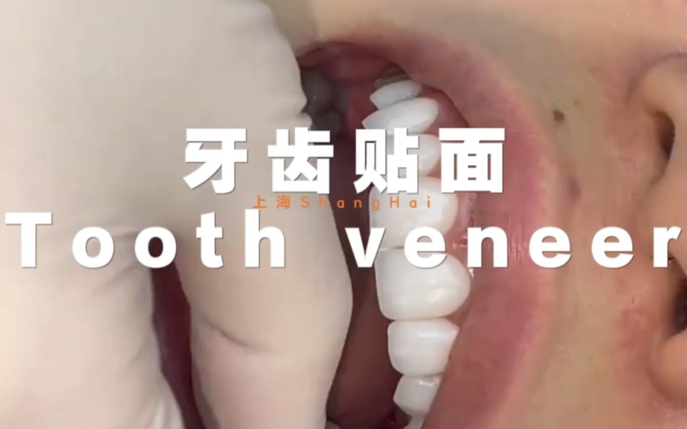 这款牙齿贴面喜欢吗Do you like this tooth veneer?上海大唐口腔 牙齿贴面美学美白全瓷 上海口腔医院 哪里补牙好 最好的口腔医生哔哩哔哩bilibili