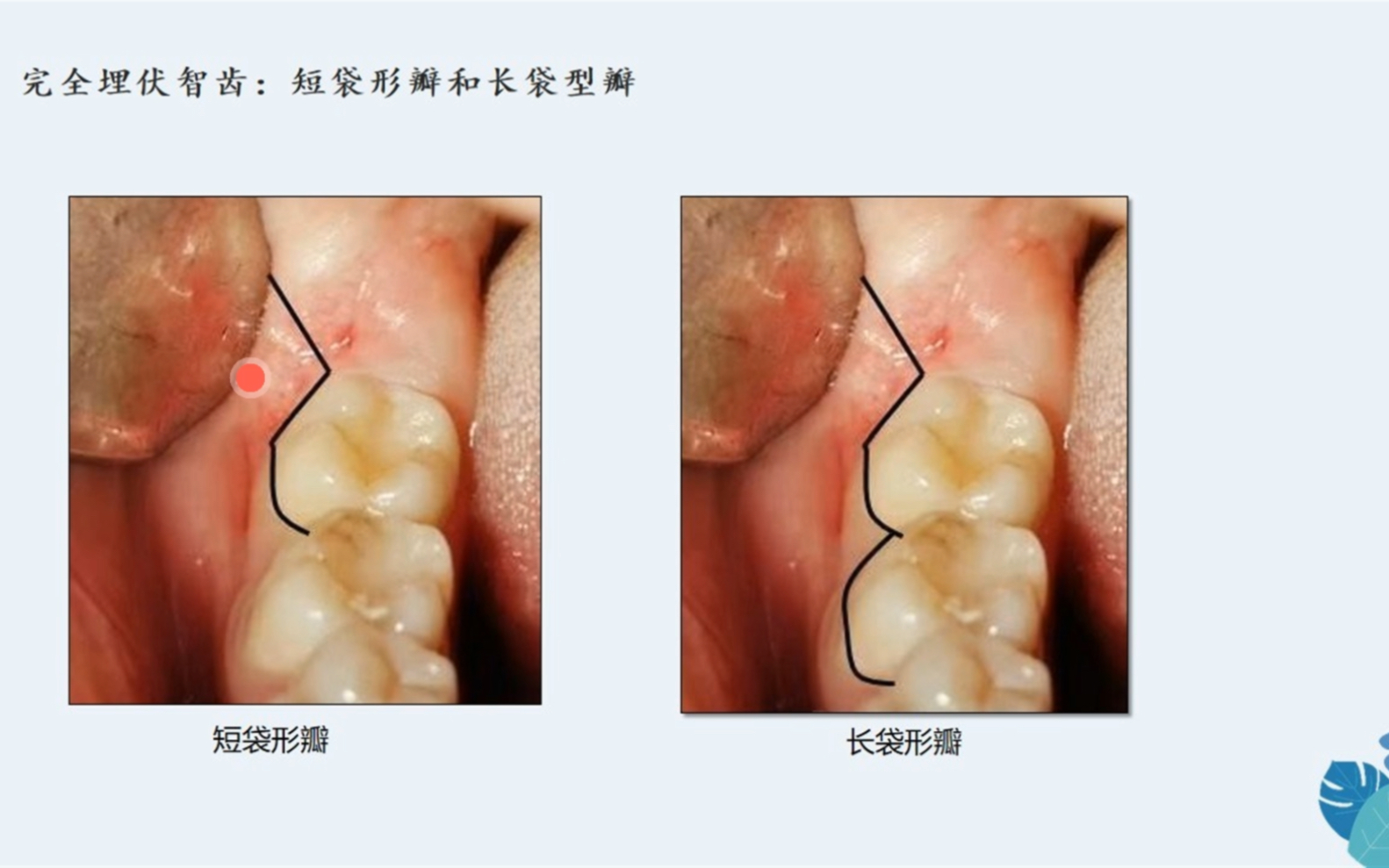 [图]刘洋 《见微知著 微创拔牙的剑与道》—埋伏牙拔除方案设计