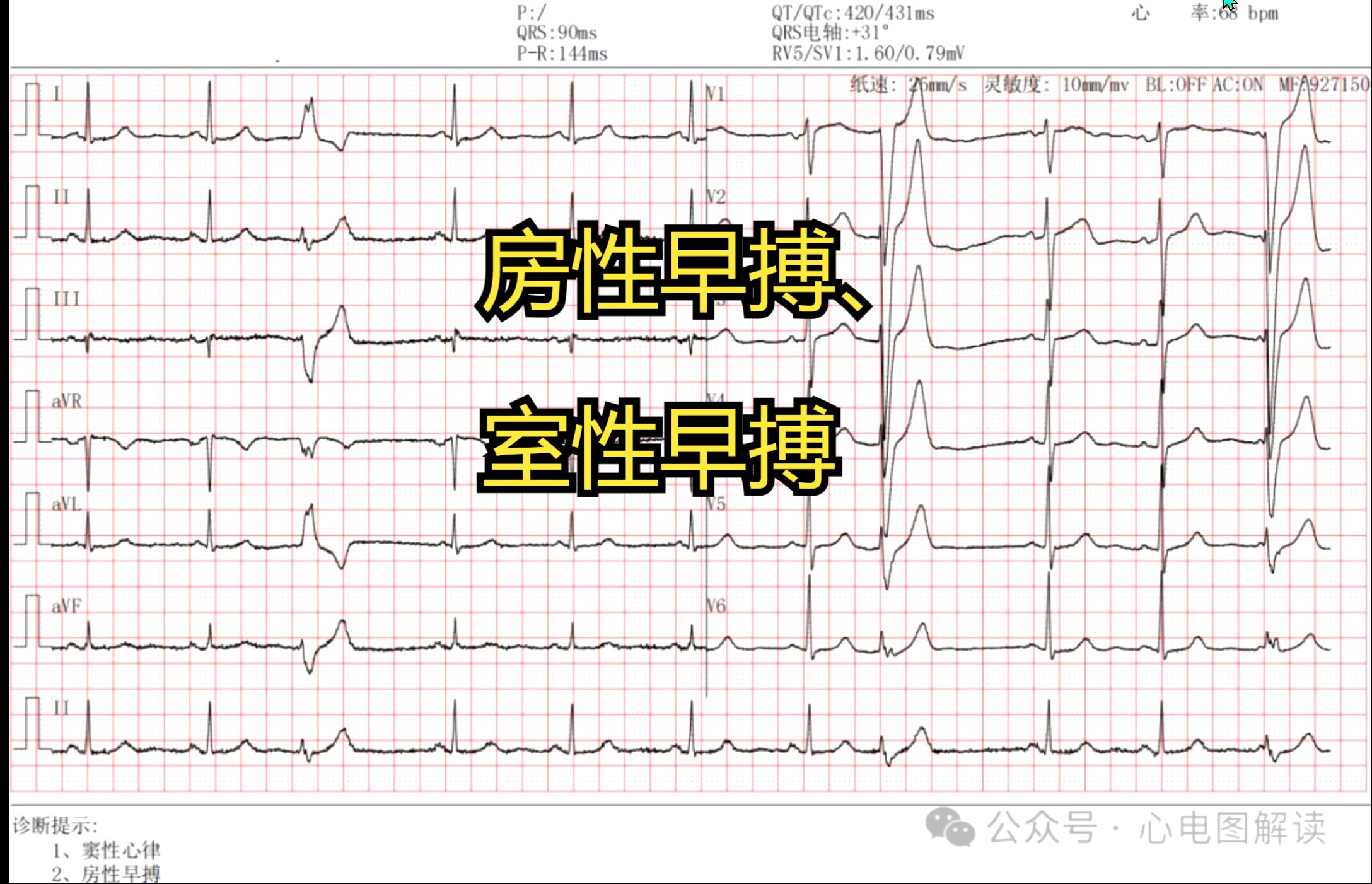 房性早搏、室性早搏哔哩哔哩bilibili