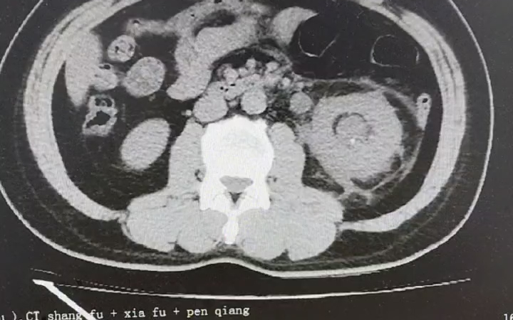 泌尿系ct 左侧输尿管盆段结石 左肾周渗出