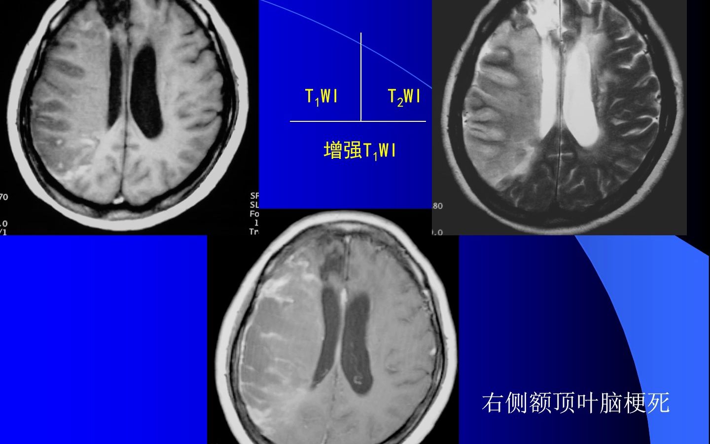 MRI中枢神经系统哔哩哔哩bilibili