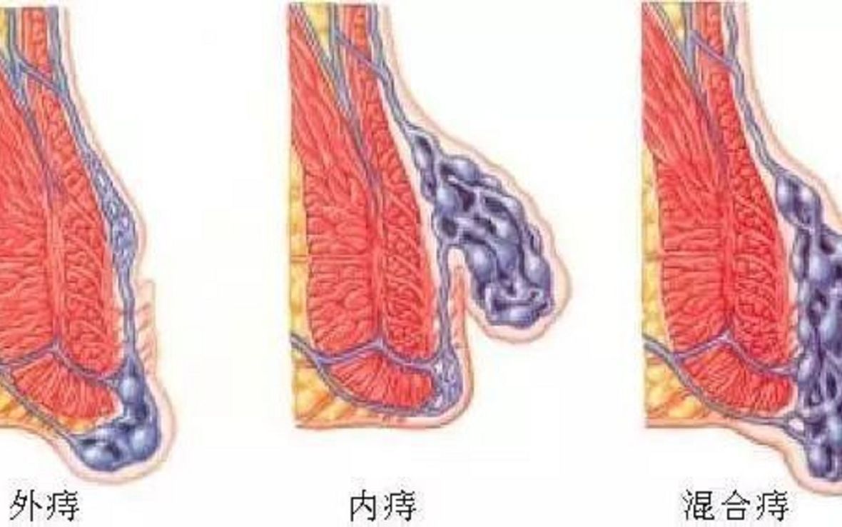 爆款痔疮药测评来袭!数十万人用的痔疮膏真的很靠谱,一招即可消除肉球!哔哩哔哩bilibili