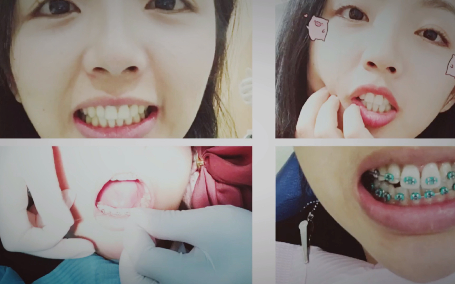 绑牙那些事箍牙戴牙套