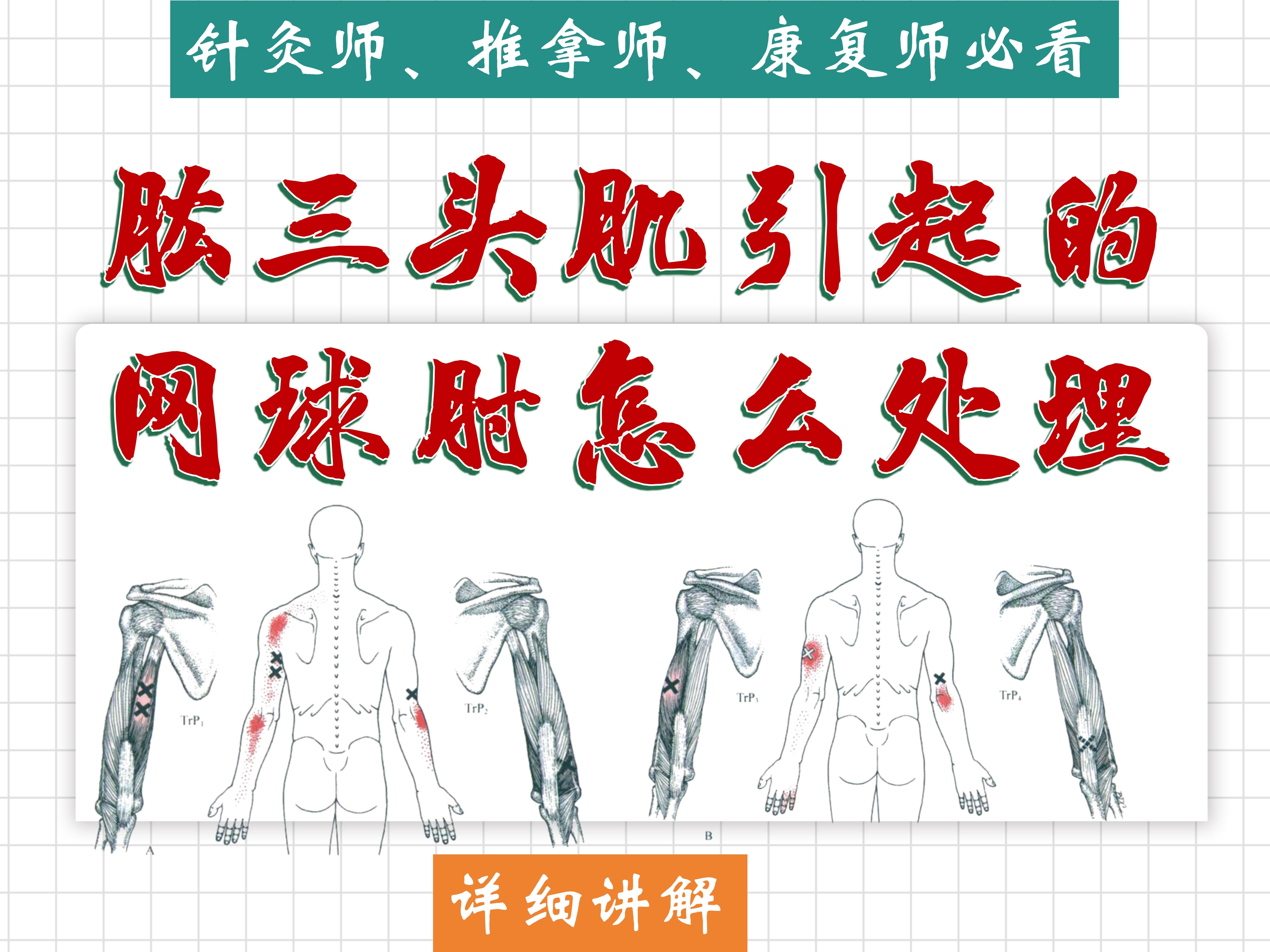 【肱三头肌】引起的网球肘(肱骨外上髁炎)详细讲解——肱三头肌的位置、功能、激痛点、处理方法——天下明医平台简灵奇针哔哩哔哩bilibili