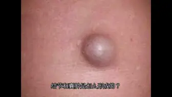 Download Video: 什么样的人易患结节和囊肿？