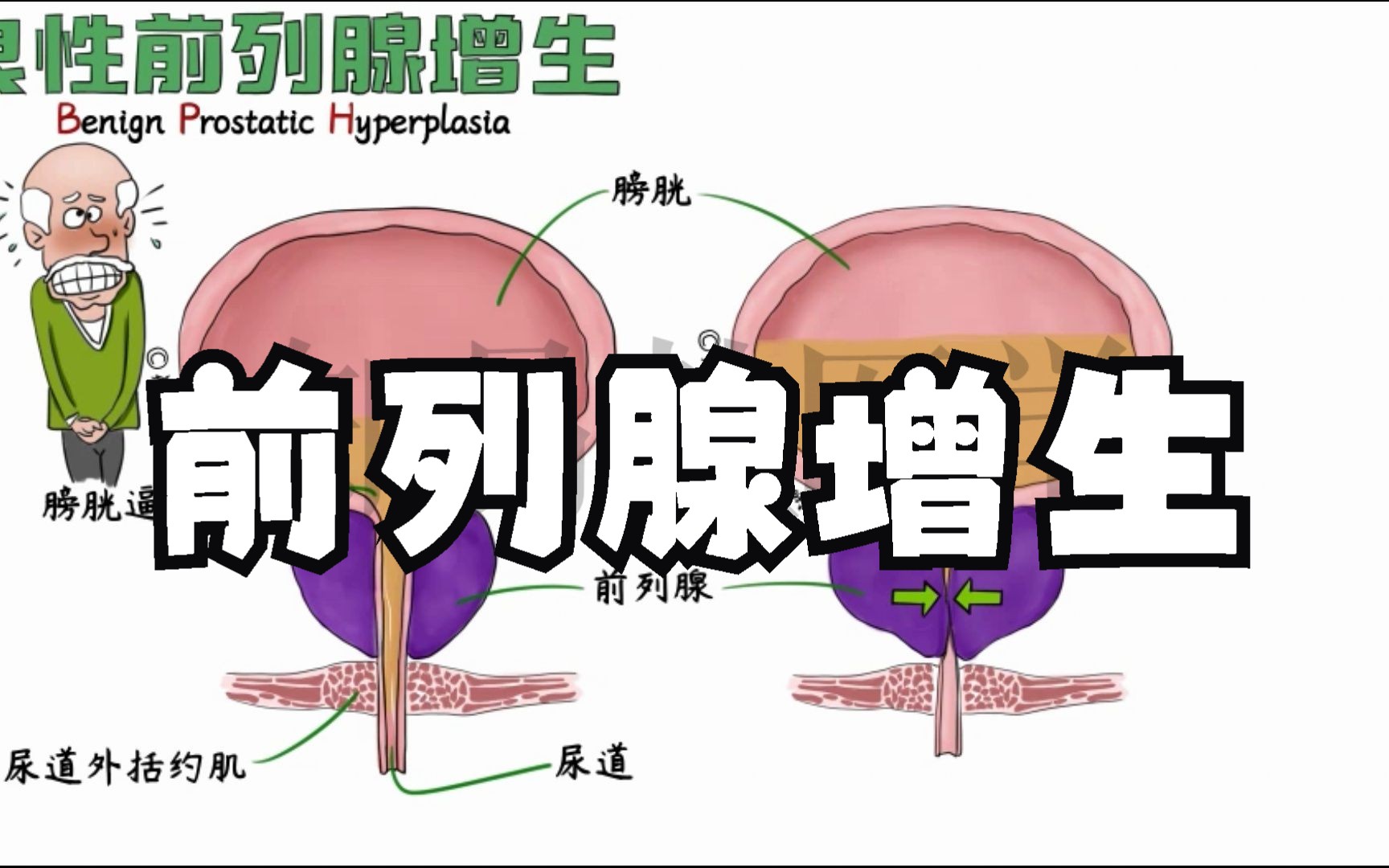 医学动画演绎【前列腺肥大】机制+症状+所有治疗方法哔哩哔哩bilibili