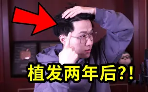 Download Video: 植发效果到底怎么样？2年后我后悔了吗？！【植发经历大分享】