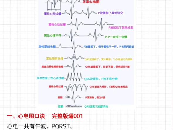 一图教你看会心电图哔哩哔哩bilibili