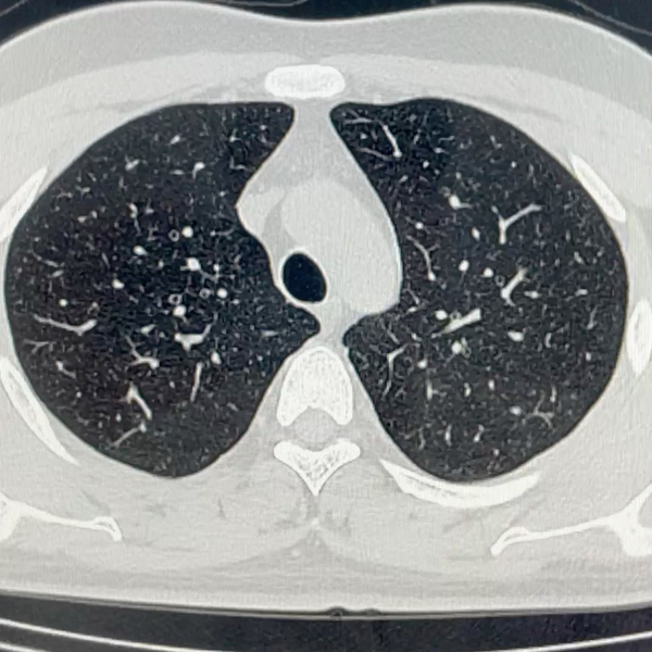 正常胸部ct的肺窗影像_哔哩哔哩_bilibili