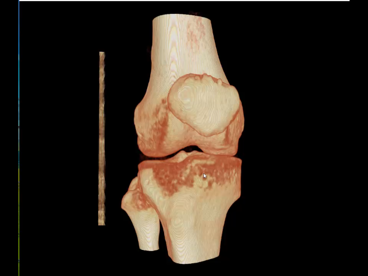 膝关节ct三维重建图片图片