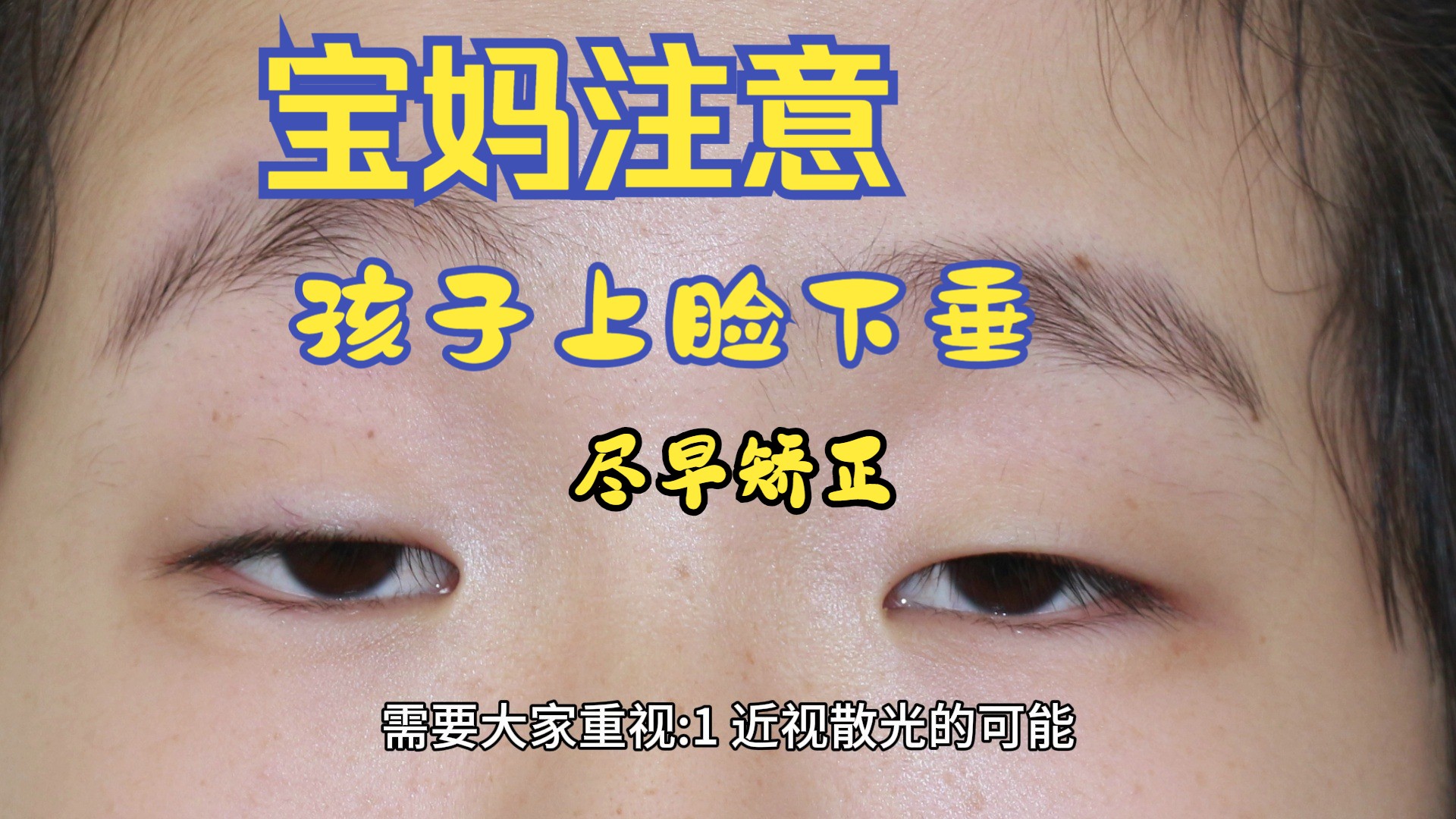 儿童先天性上睑下垂一经发现需要尽早咨询专业医生,采取合适的矫正