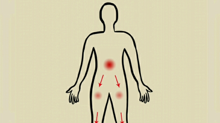 腰椎间盘突出症状下腹部痛或大腿前侧痛:在高位腰椎间盘突出症,当腰2、3、4神经根受累时,则出现神经根支配区的下腹部腹股沟区或大腿前内侧疼痛...