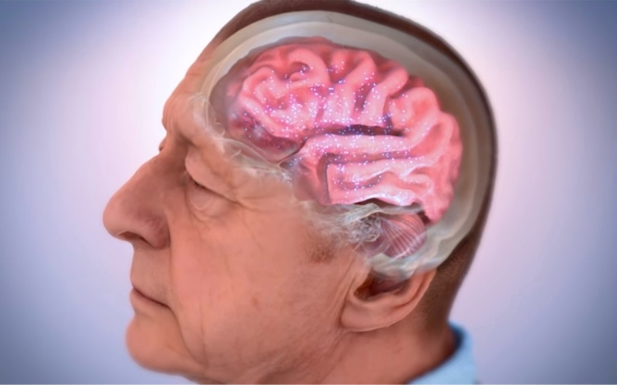 阿尔兹海默症如何改变大脑的 (美国国家阿尔兹海默症研究中心三年前