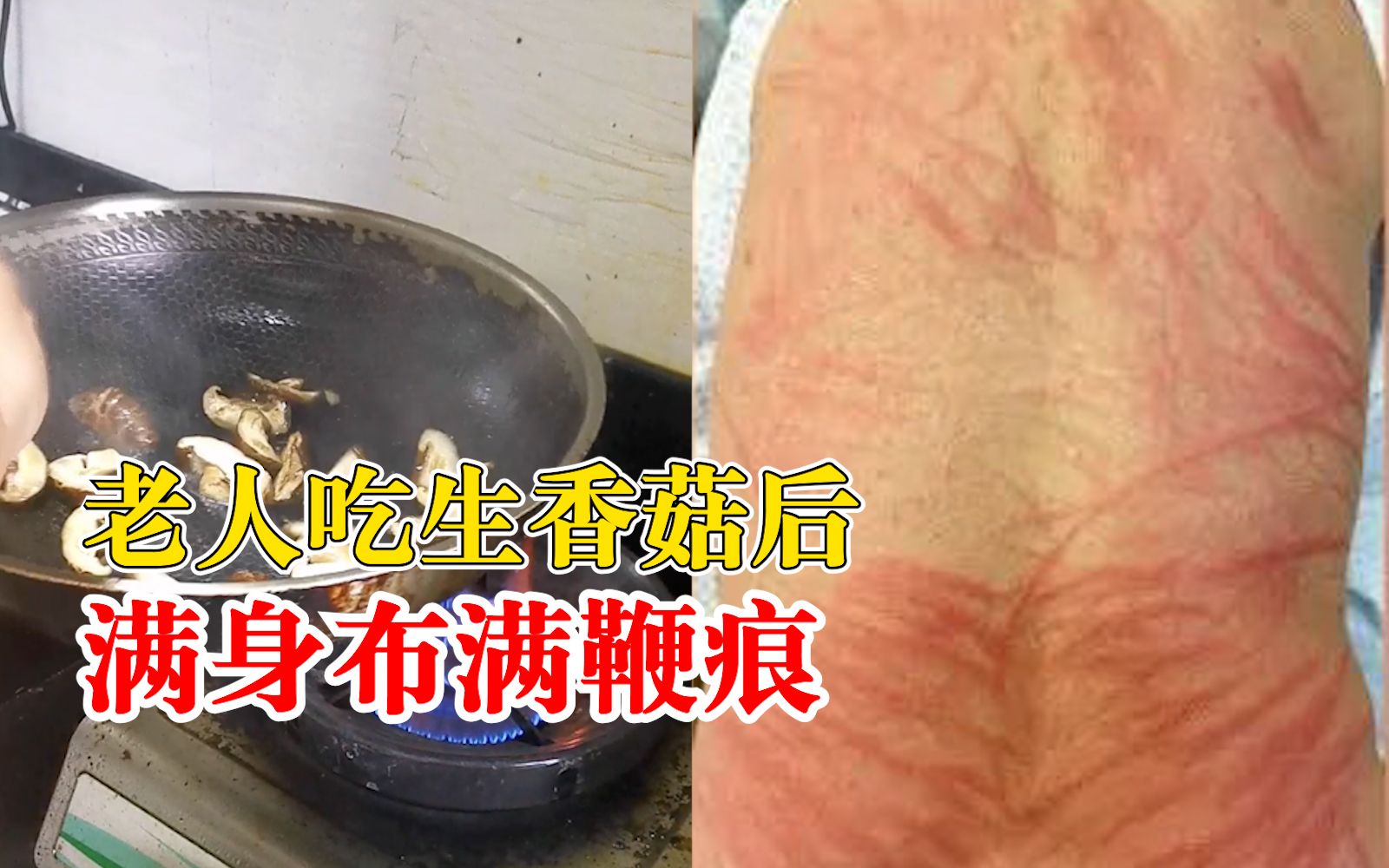 老人吃生香菇后满身布满鞭痕,医生:由香菇诱导的鞭状红斑哔哩哔哩bilibili